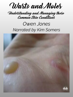 cover image of Warts And Moles
